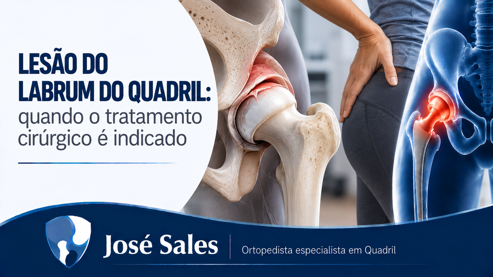 lesão do labrum do quadril